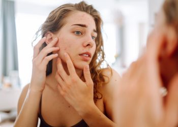 γυναίκα με ακμή