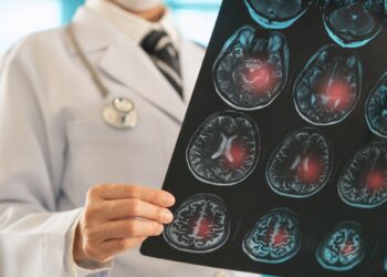 Εγκεφαλικό: Η ομάδα αίματος που συνδέεται με αυξημένο κίνδυνο 