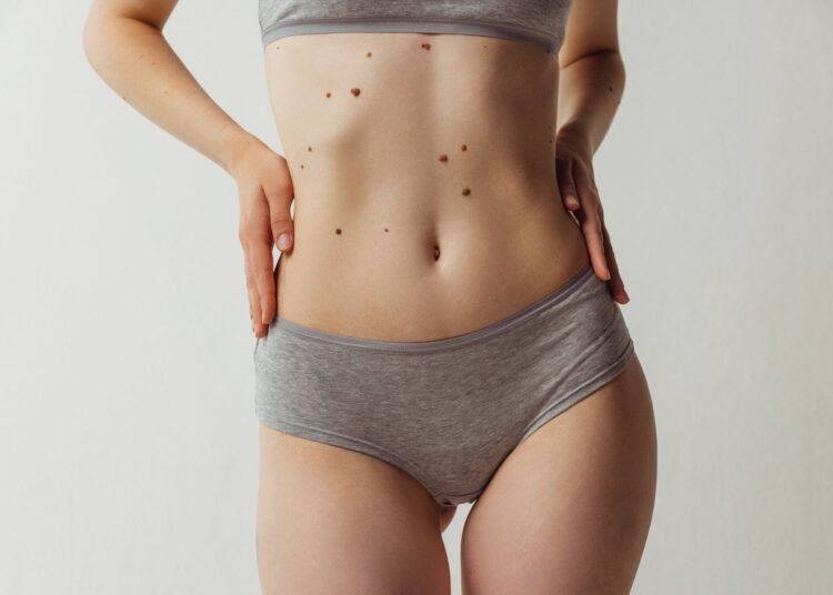 Πότε πρέπει να κάνουμε χαρτογράφηση σπίλων;