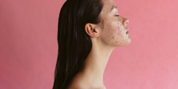 Ακμή και περίοδος: Πώς συνδέονται;