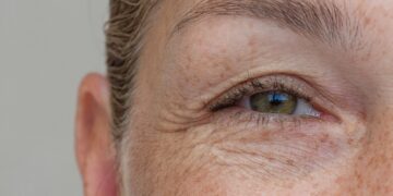 Υπάρχει τρόπος να μειώσουμε τις ρυτίδες έκφρασης