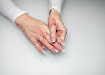 Πώς επηρεάζει το άγχος το δέρμα;