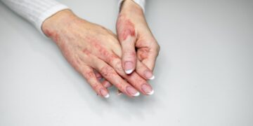 Πώς επηρεάζει το άγχος το δέρμα;