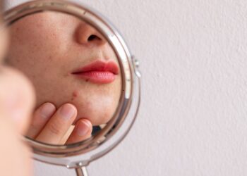 Ακμή ενηλίκων: Αίτια και θεραπεία