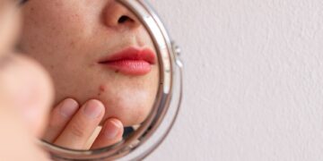 Ακμή ενηλίκων: Αίτια και θεραπεία