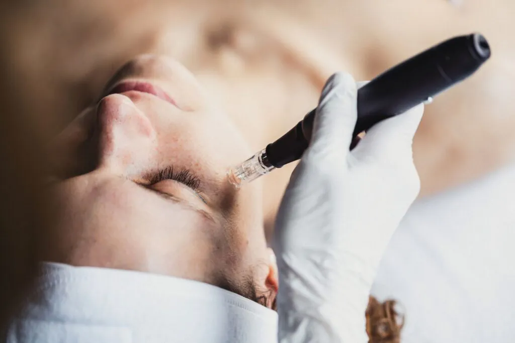 Microneedling: Πώς λειτουργεί για το δέρμα μας;